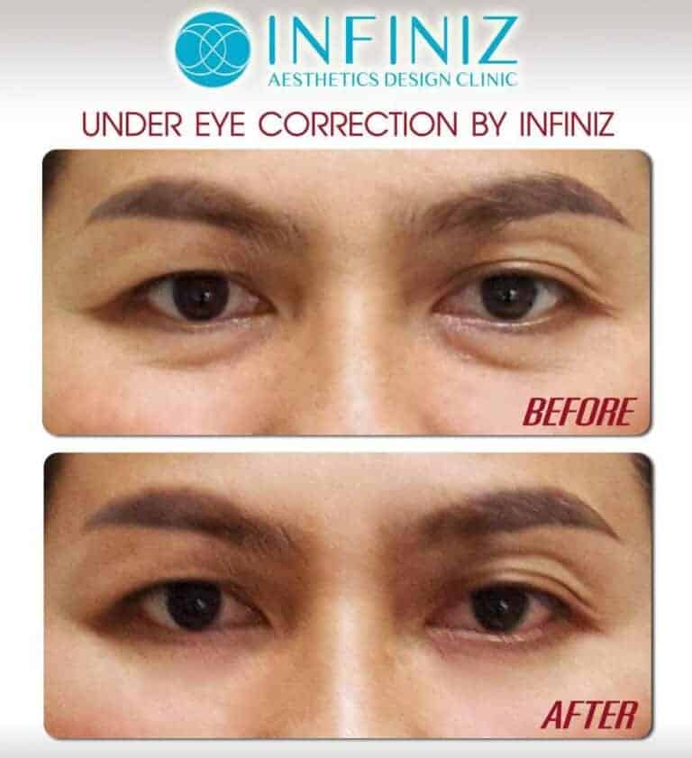 Under Eye Rejuvenation : การแก้ไขปัญหาร่องใต้ตา - Infiniz Clinic 4 150512 1 1