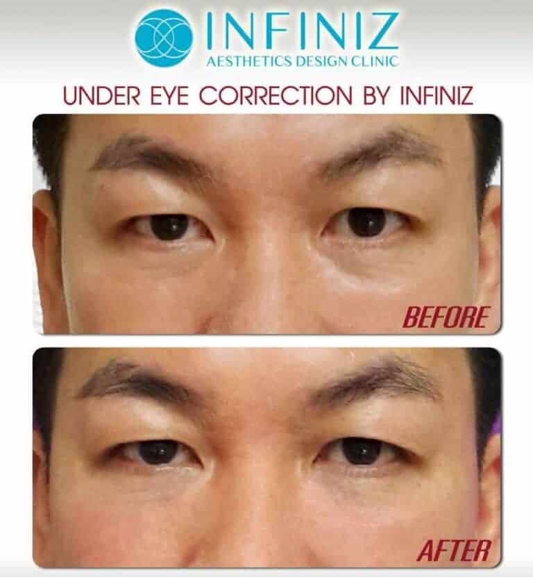 Under Eye Rejuvenation : การแก้ไขปัญหาร่องใต้ตา - Infiniz Clinic 3 150512 2