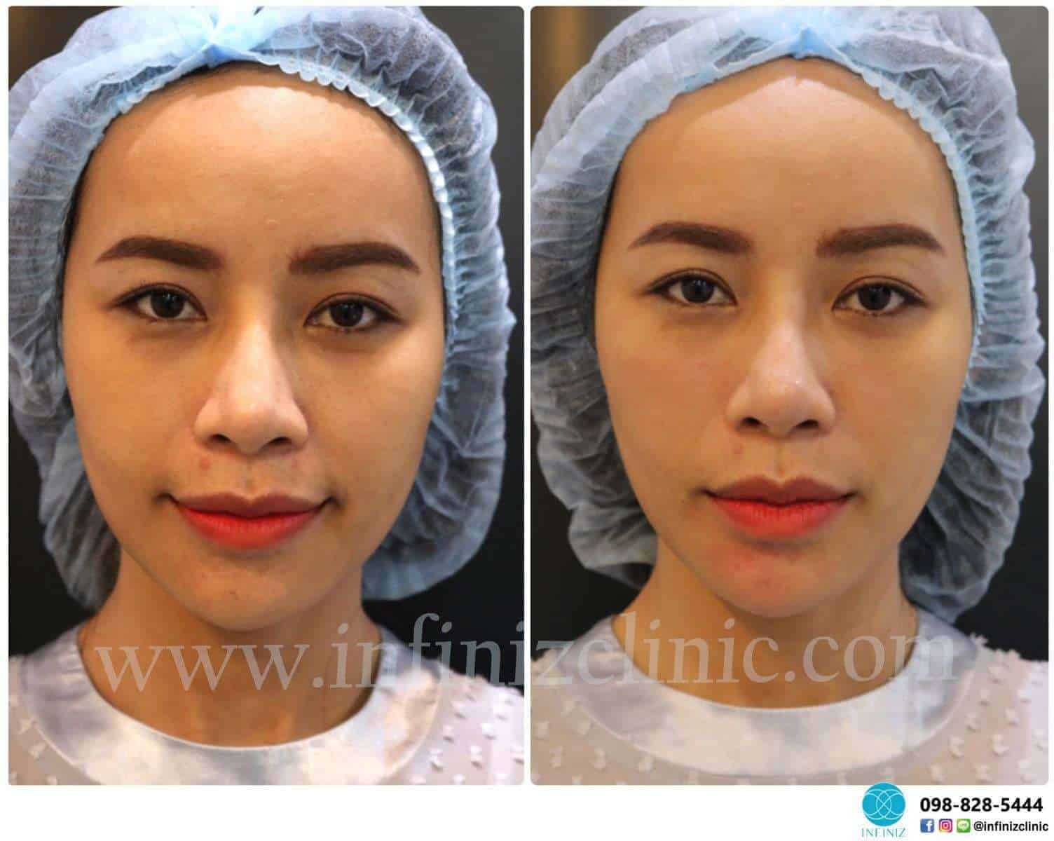 ข้อแตกต่างของการทำ 3D Skinboosters กับการฉีด HA Filler แบบเดิม ๆ 2 3D skinbooster1
