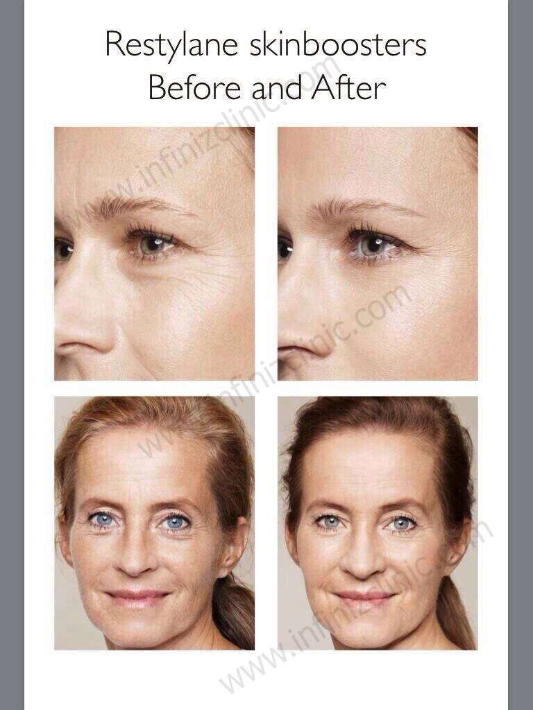 เพิ่มความชุ่มชื่นให้ผิว ต้องรู้จัก Skinboosters 6 S 5148427857699