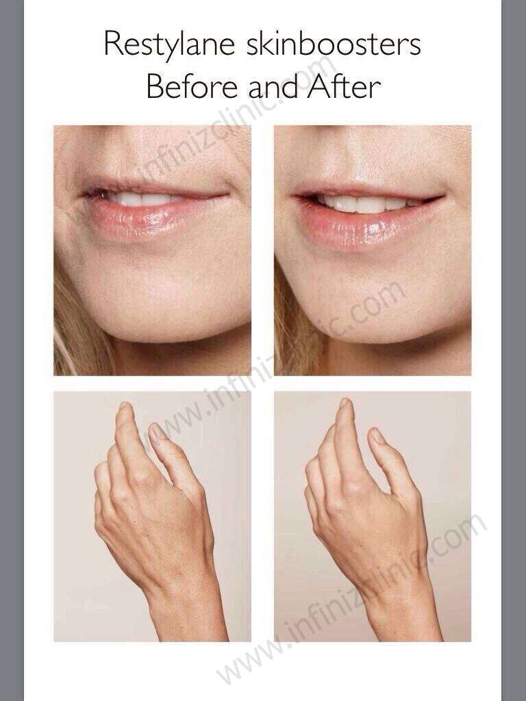 เพิ่มความชุ่มชื่นให้ผิว ต้องรู้จัก Skinboosters 8 S 5148427884441