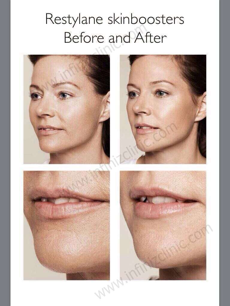 เพิ่มความชุ่มชื่นให้ผิว ต้องรู้จัก Skinboosters 5 S 5148427987373