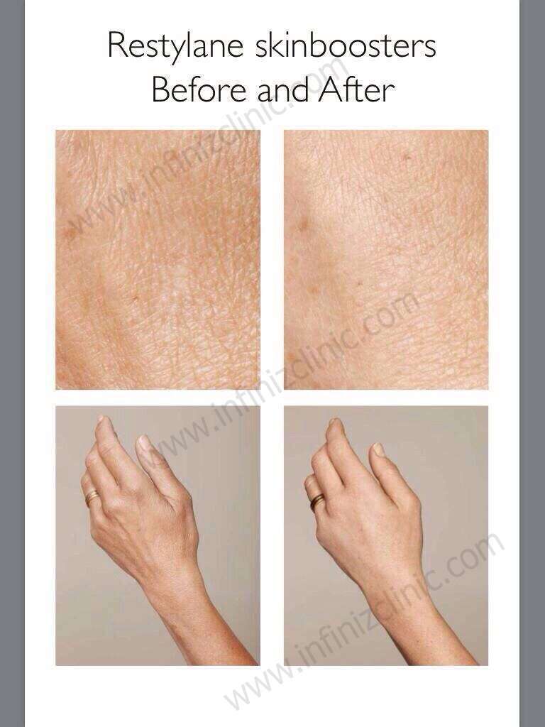 เพิ่มความชุ่มชื่นให้ผิว ต้องรู้จัก Skinboosters 7 S 5148428013392