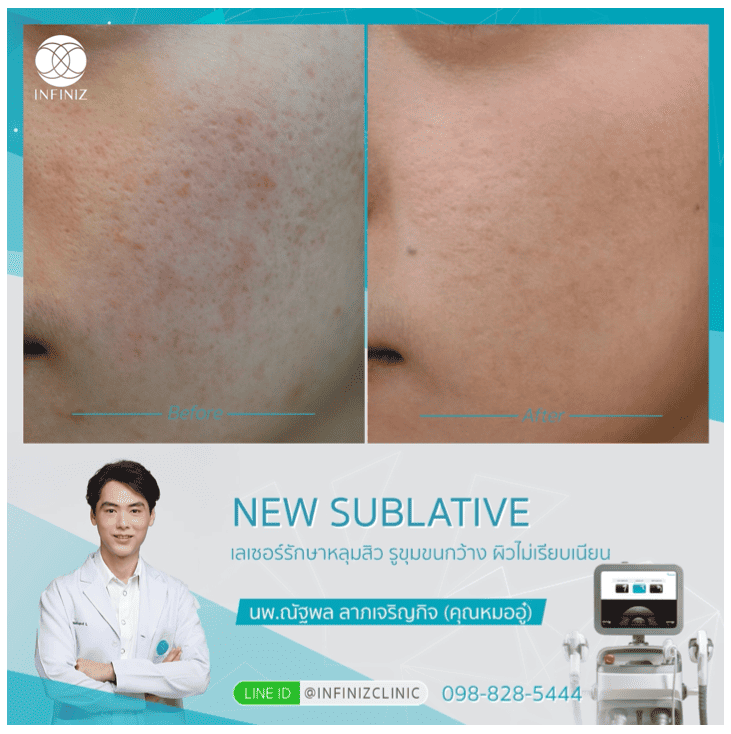 โปรแกรมรักษาสิว 10 Acne Away Plus 10