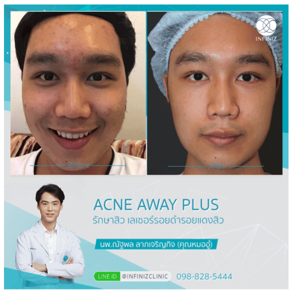 โปรแกรมรักษาสิว 2 Acne Away Plus 2