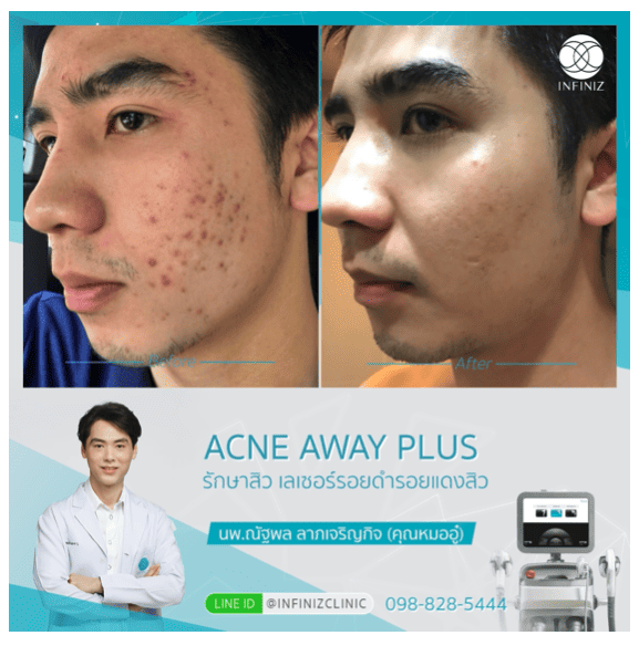 โปรแกรมรักษาสิว 3 Acne Away Plus 3