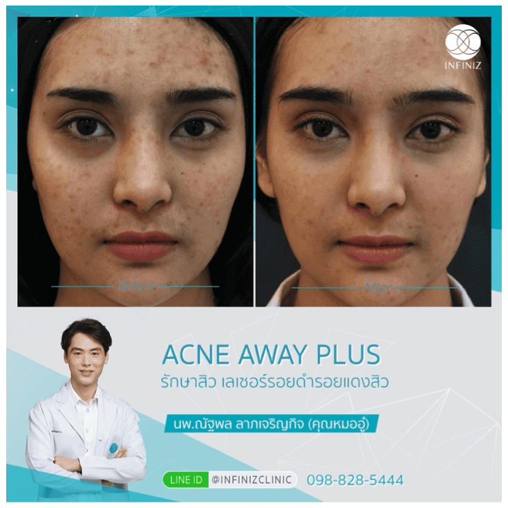 โปรแกรมรักษาสิว 6 Acne Away Plus 6