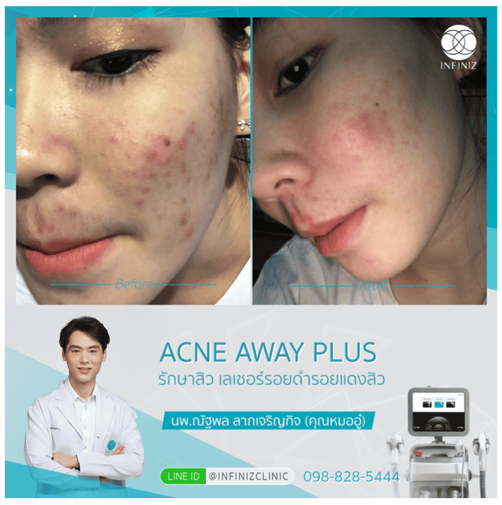 โปรแกรมรักษาสิว 7 Acne Away Plus 7