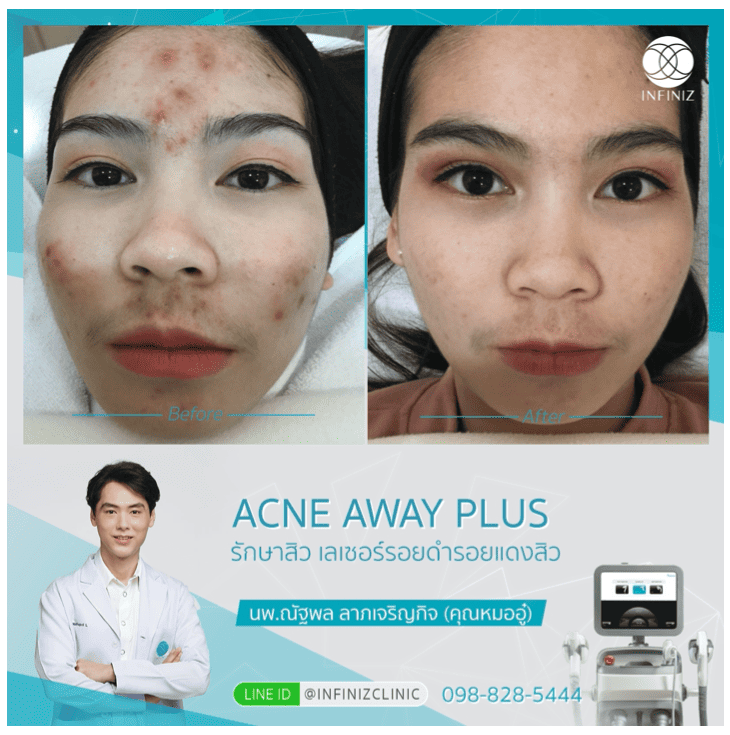 โปรแกรมรักษาสิว 8 Acne Away Plus 8