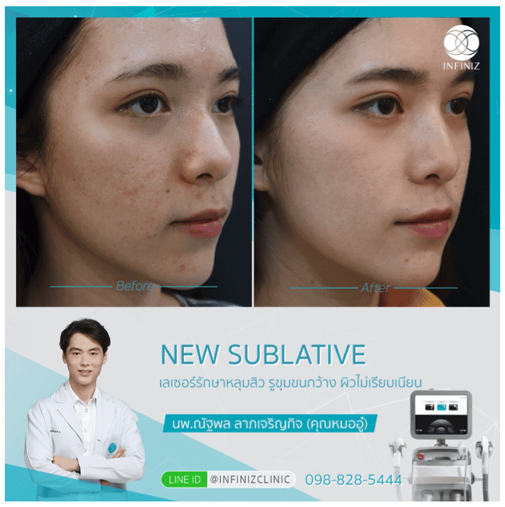 โปรแกรมรักษาสิว 9 Acne Away Plus 9