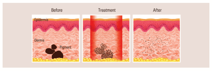 CO2 Laser 1 CO2 Laser 1
