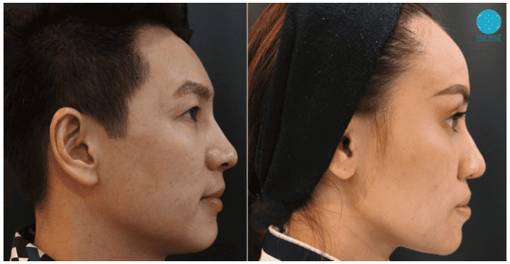 โปรแกรมฟิลเลอร์หน้าผาก Harmony Technique (Perfect Forehead) 2 Perfect Forehead 2