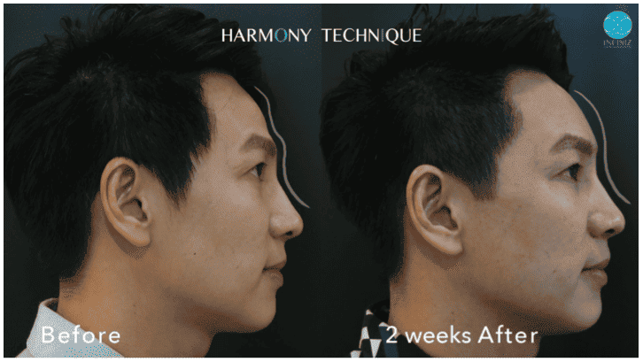 โปรแกรมฟิลเลอร์หน้าผาก Harmony Technique (Perfect Forehead) 3 Perfect Forehead 3