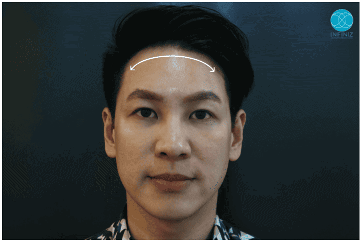 โปรแกรมฟิลเลอร์หน้าผาก Harmony Technique (Perfect Forehead) 4 Perfect Forehead 4