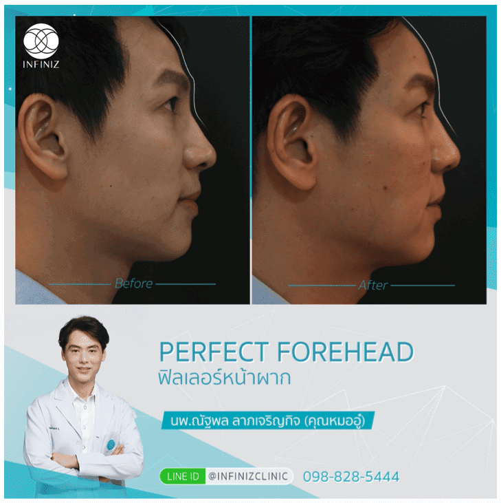 โปรแกรมฟิลเลอร์หน้าผาก Harmony Technique (Perfect Forehead) 5 Perfect Forehead 5