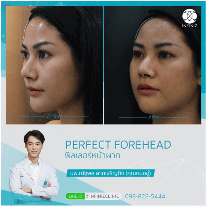 โปรแกรมฟิลเลอร์หน้าผาก Harmony Technique (Perfect Forehead) 6 Perfect Forehead 6