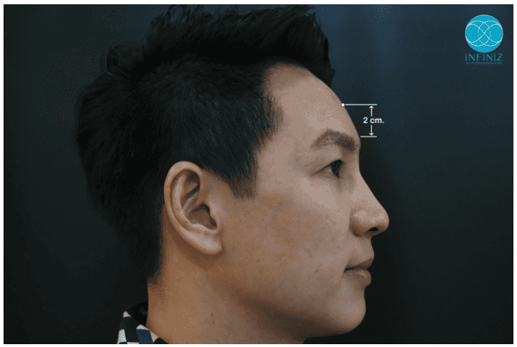 โปรแกรมฟิลเลอร์หน้าผาก Harmony Technique (Perfect Forehead) 1 Perfect Forehead
