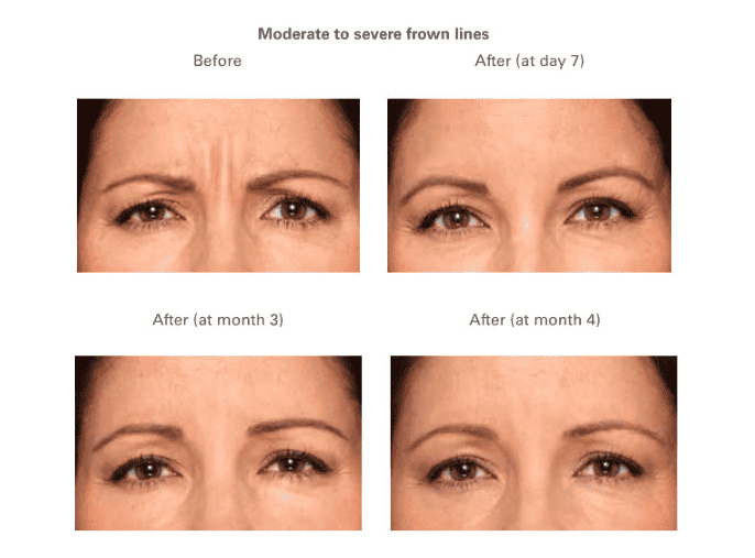 USA - โบอเมริกา 2 USA Botulinum Toxin 2