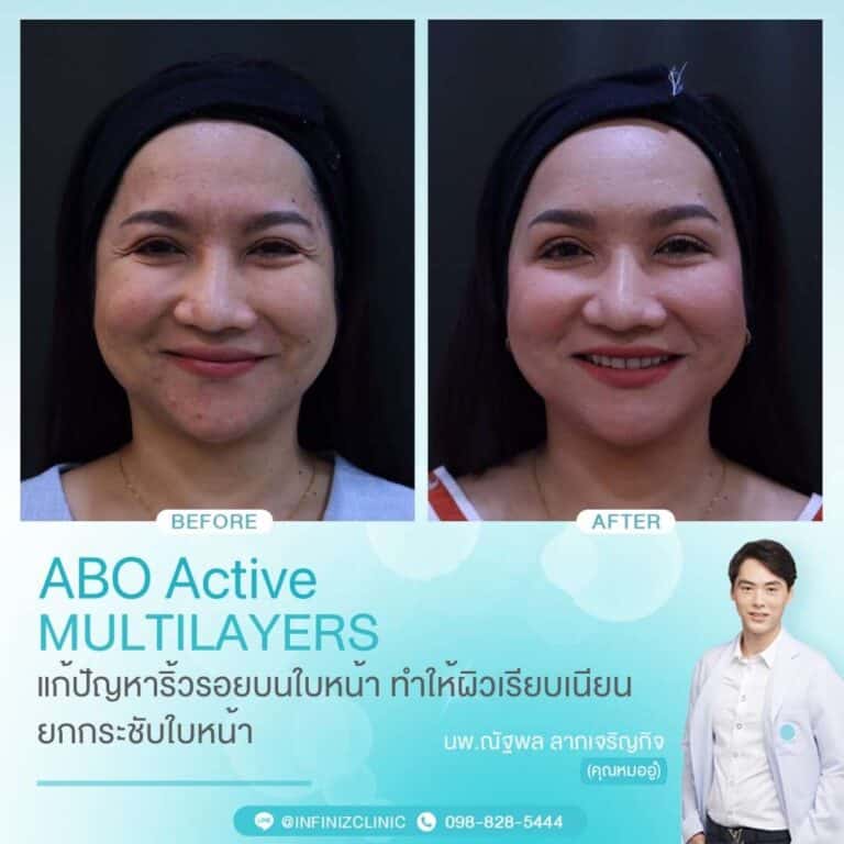 ABO Active 1 1