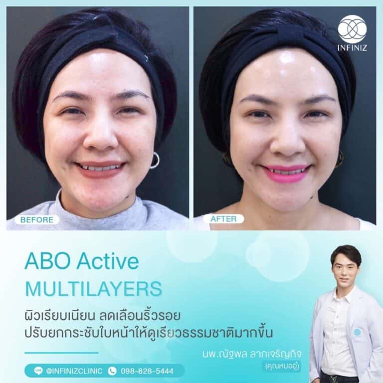 ABO Active 2 2