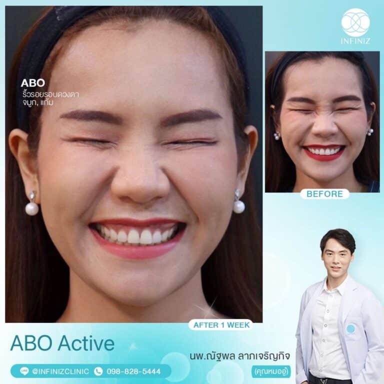 ABO Active 5 5