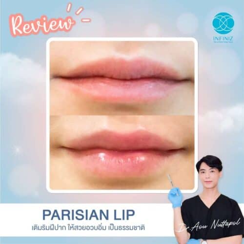 ฉีดฟิลเลอร์ปากครั้งแรกต้องรู้อะไรบ้าง? ราคาเท่าไหร่ อยู่ได้ประมาณแค่ไหน 5 ฟิลเลอร์ปากอวบอิ่ม