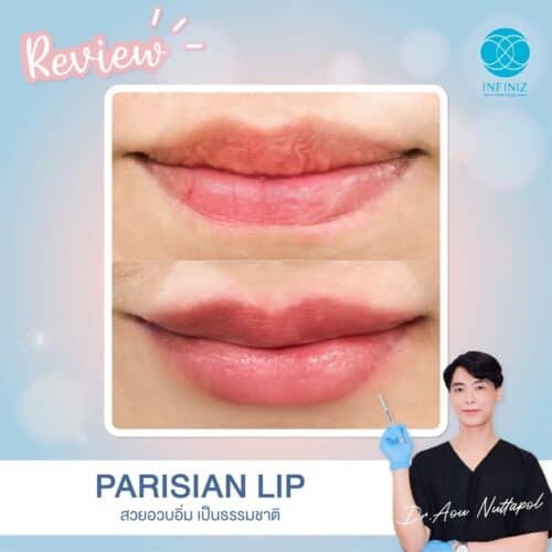 ฉีดฟิลเลอร์ปากครั้งแรกต้องรู้อะไรบ้าง? ราคาเท่าไหร่ อยู่ได้ประมาณแค่ไหน 6 ฟิลเลอร์ปากธรรมชาติ
