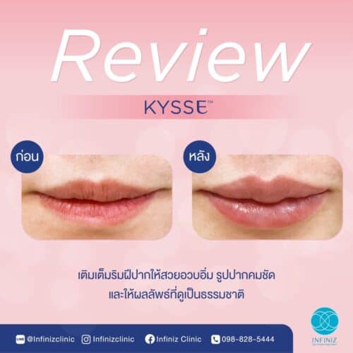 ฉีดฟิลเลอร์ปากครั้งแรกต้องรู้อะไรบ้าง? ราคาเท่าไหร่ อยู่ได้ประมาณแค่ไหน 7 ฟิลเลอร์ขอบปากคม