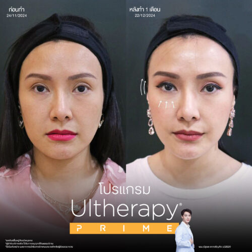 โปรแกรม Ulthera ด้วยเทคนิคจาก Infiniz ทำให้เจ็บลดลง 80% 2 BA Prime 09