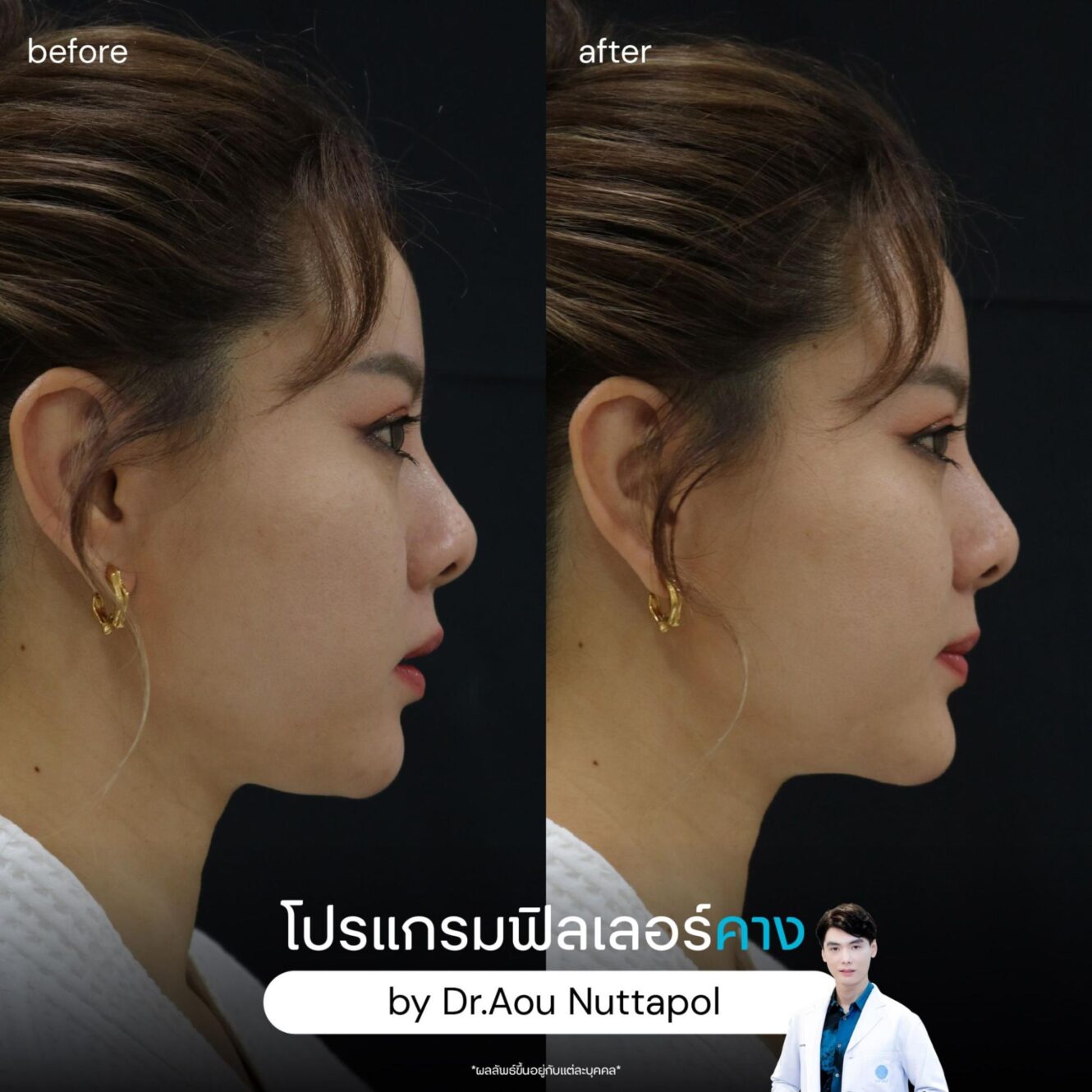 แพทย์ 17 ก่อนฉีดฟิลเลอร์คาง