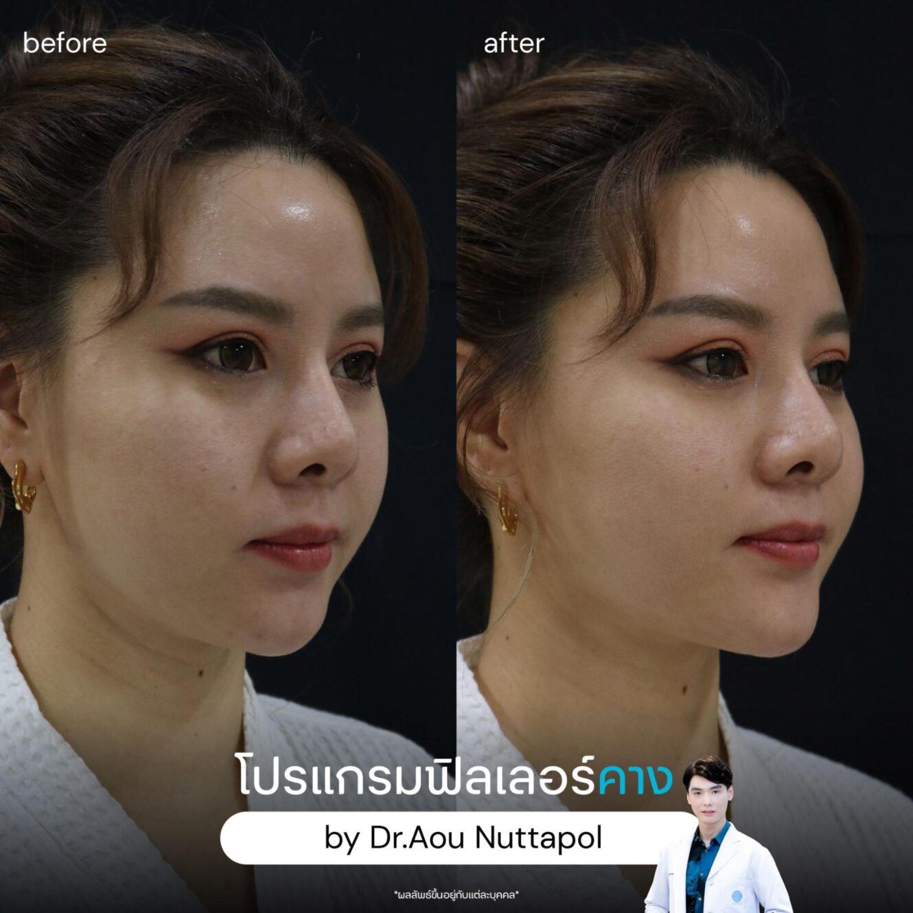 แพทย์ 15 ฟิลเลอร์คาง ข้อดี