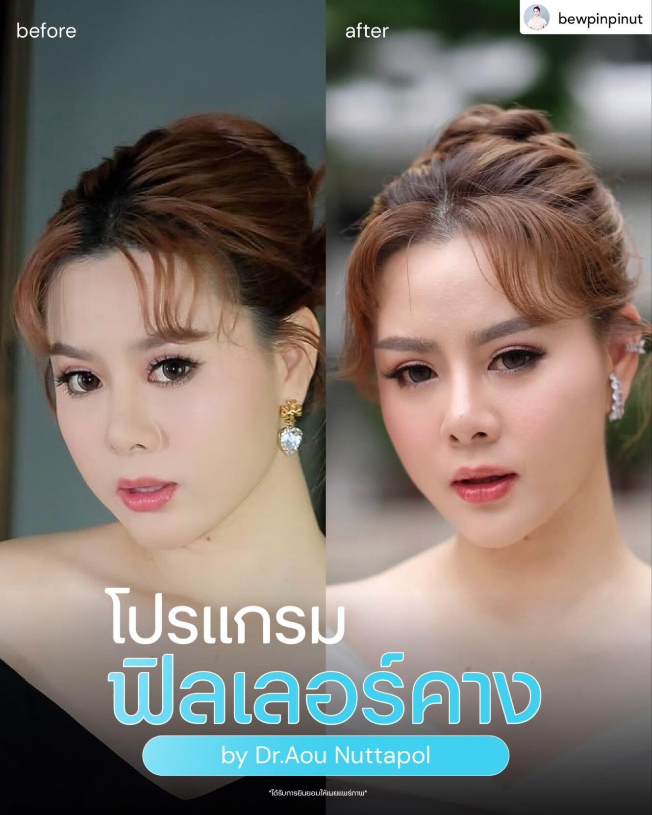 แพทย์ 16 ฟิลเลอร์คาง คือ