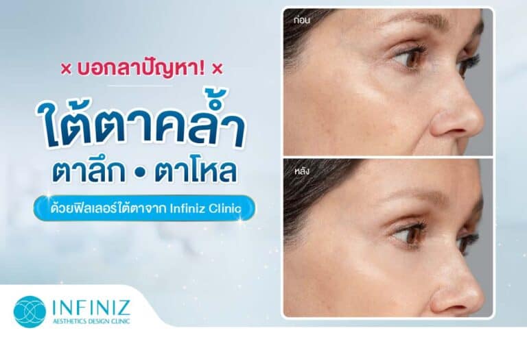 บอกลาปัญหา! ใต้ตาคล้ำ ตาลึก ตาโหลด้วย Filler จาก Infiniz Clinic 20 02 ปัญหาใต้ตาคล้ำ Infiniz 1
