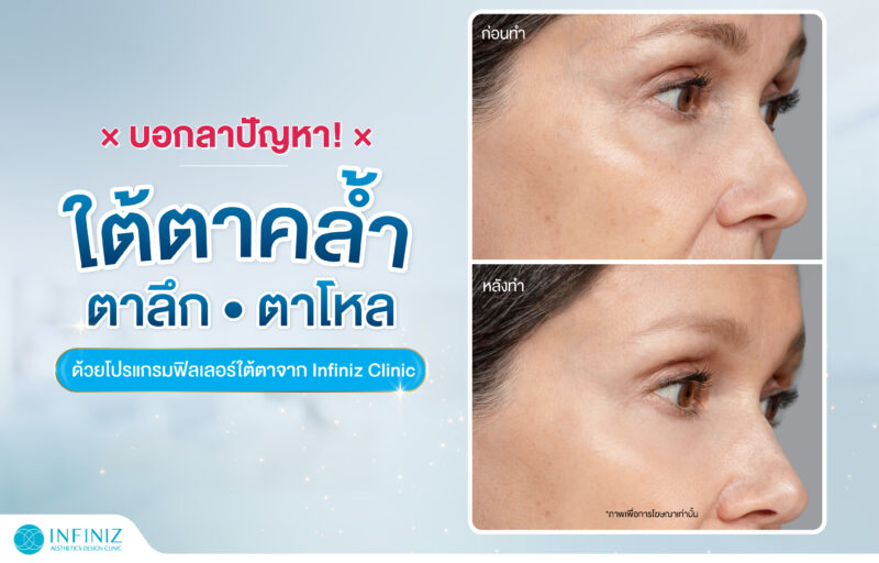 บอกลาปัญหา! ใต้ตาคล้ำ ตาลึก ตาโหลด้วย Filler จาก Infiniz Clinic 1 web Sep 23 04