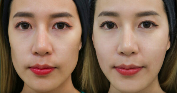 เจาะลึกโปรแกรม Radiesse Filler คืออะไร ราคาเท่าไหร่ ต้องฉีดกี่ครั้งเพื่อฟื้นฟูผิว 2 BA Radiesse 01 1