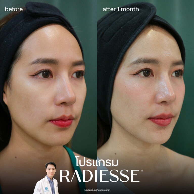 เจาะลึกโปรแกรม Radiesse Filler คืออะไร ราคาเท่าไหร่ ต้องฉีดกี่ครั้งเพื่อฟื้นฟูผิว 7 radiesse-review-3