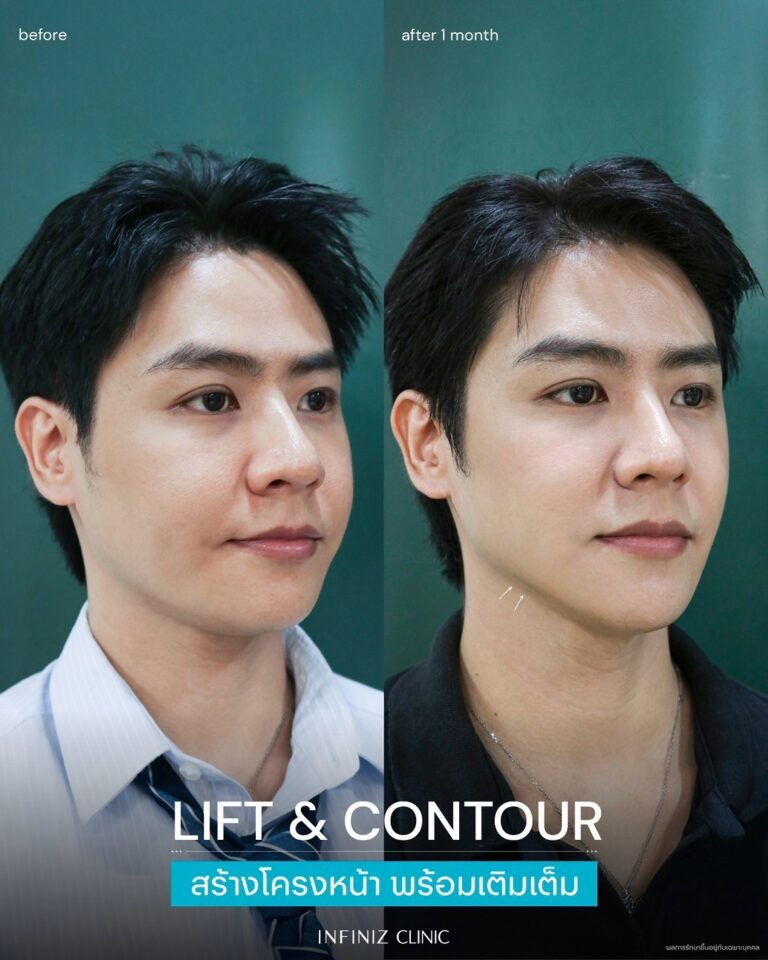 เจาะลึกโปรแกรม Radiesse Filler คืออะไร ราคาเท่าไหร่ ต้องฉีดกี่ครั้งเพื่อฟื้นฟูผิว 9 radiesse-men-review-2
