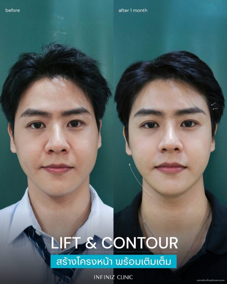 เจาะลึกโปรแกรม Radiesse Filler คืออะไร ราคาเท่าไหร่ ต้องฉีดกี่ครั้งเพื่อฟื้นฟูผิว 8 radiesse-men-review