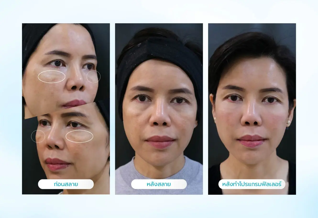 ฟิลเลอร์ใต้ตาเป็นก้อนแก้ไขได้อย่างไร ฉีดสลายได้หรือไม่? 3 วิธีป้องกันไม่ให้หลังทำโปรแกรมฟิลเลอร์ใต้ตาแล้วกลายเป็นก้อน