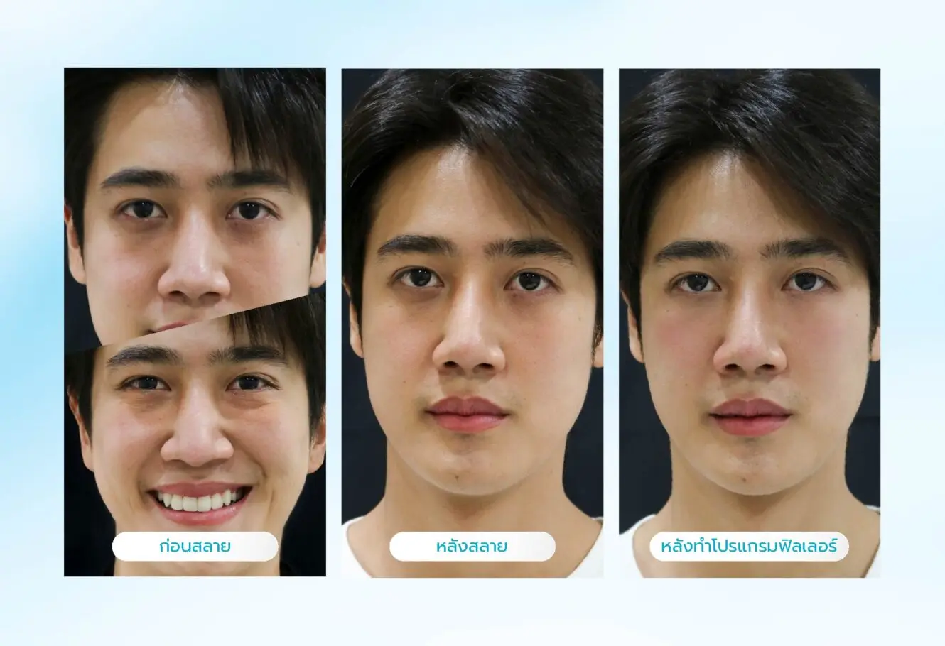 ฟิลเลอร์ใต้ตาเป็นก้อนแก้ไขได้อย่างไร ฉีดสลายได้หรือไม่? 4 วิธีป้องกันไม่ให้หลังทำโปรแกรมฟิลเลอร์ใต้ตาแล้วกลายเป็นก้อน
