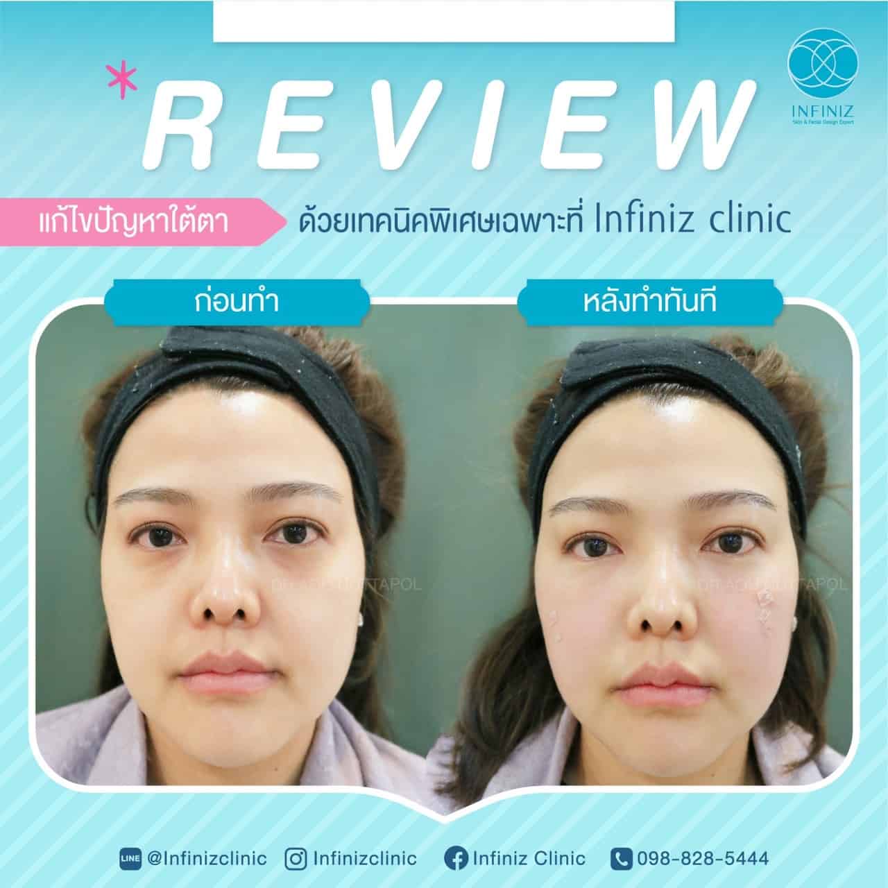 หลังฉีดฟิลเลอร์ใต้ตาดูแลตัวเองอย่างไร? เพื่อผลลัพธ์ที่มีประสิทธิภาพ 3 รีวิวหลังฉีดฟิลเลอร์ใต้ตา