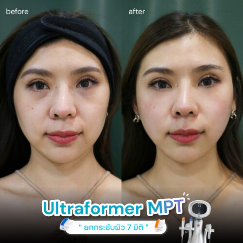 ultraformer-mpt-รีวิว