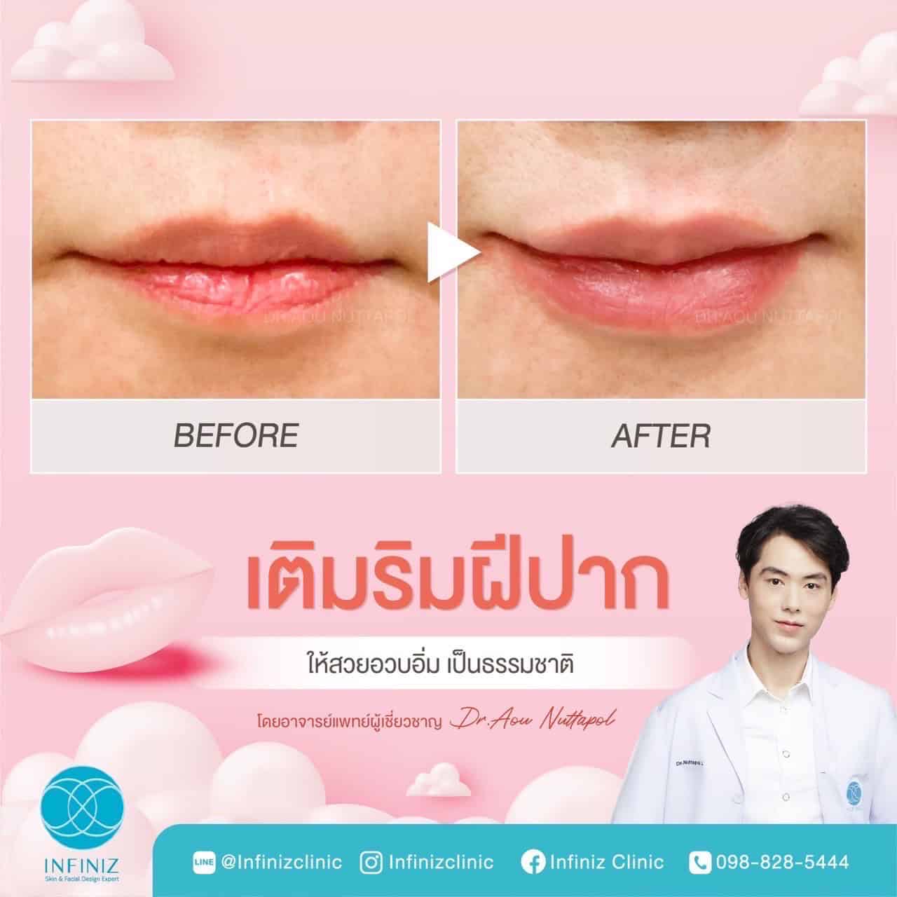 ฉีดฟิลเลอร์ปาก ยี่ห้อไหนดีที่ปลอดภัย? รวมเรื่องควรรู้ก่อนเติมฟิลเลอร์ 4 ฉีดฟิลเลอร์ปากที่ Infiniz Clinic