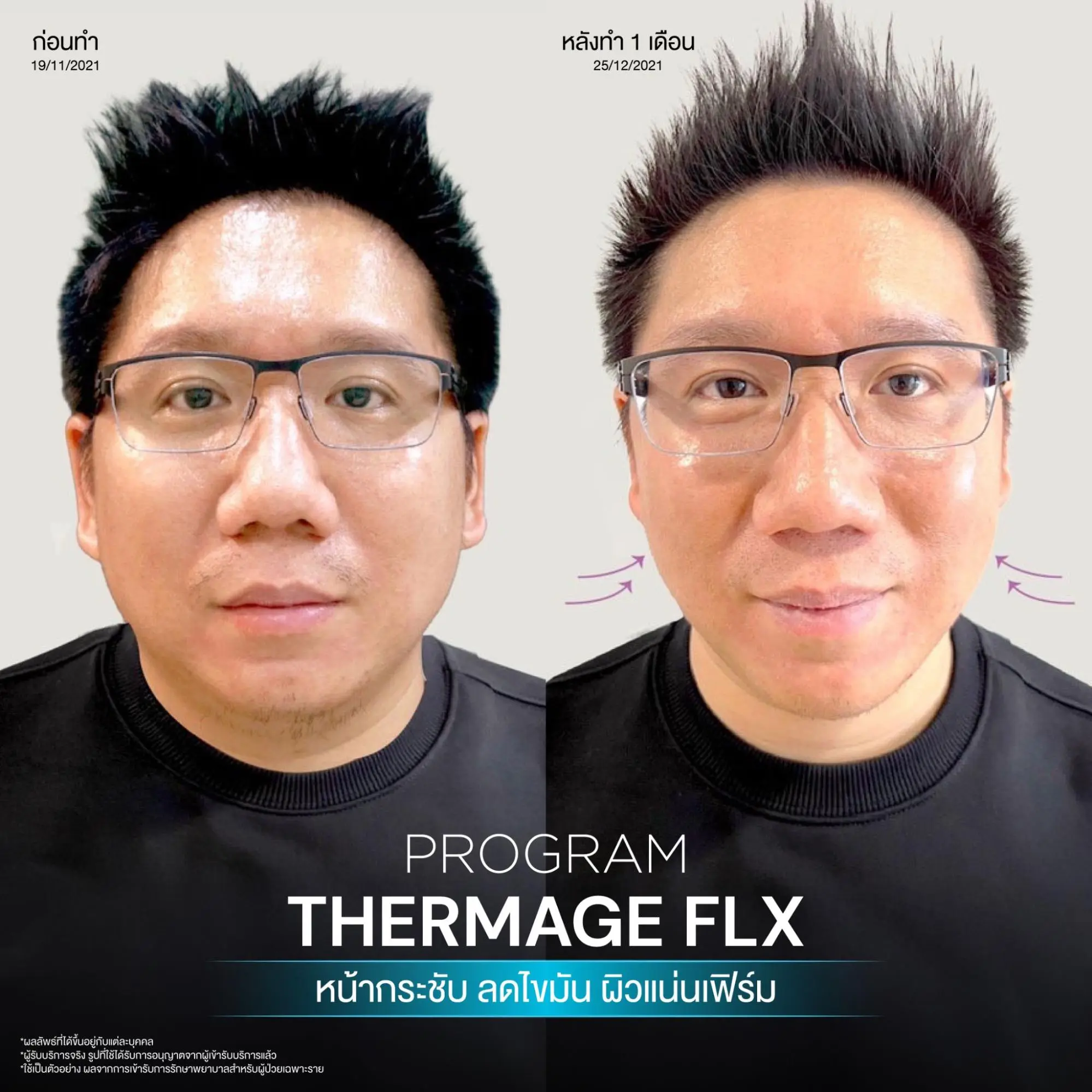 โปรแกรม Thermage ราคาเริ่มต้นเท่าไหร่? ใช้กี่ Shot หน้าถึงจะยกเห็นผลหลังทำ 5 โปรแกรม Thermage ควรทำกี่ shot