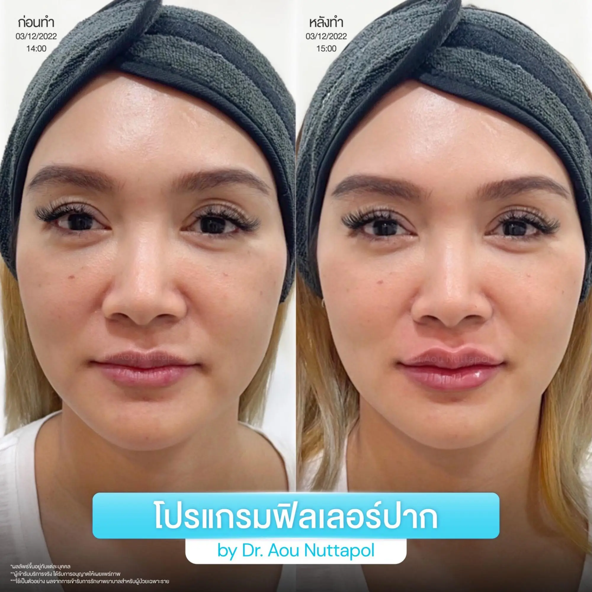 โปรแกรมฟิลเลอร์ปาก ราคาเท่าไหร่ในปี 2026? รวมราคาแต่ละรุ่น ต่างกันยังไง 5 ทำโปรแกรมฟิลเลอร์ปากที่ INFINIZ Clinic