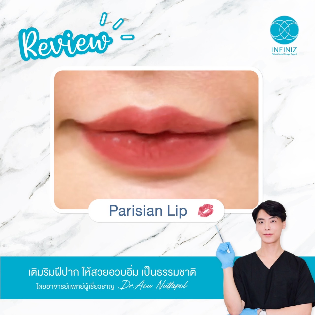 ฟิลเลอร์ยกมุมปาก แก้ปัญหามุมปากตกอย่างไร อันตรายไหม? 3 ฉีดฟิลเลอร์ยกมุมปาก