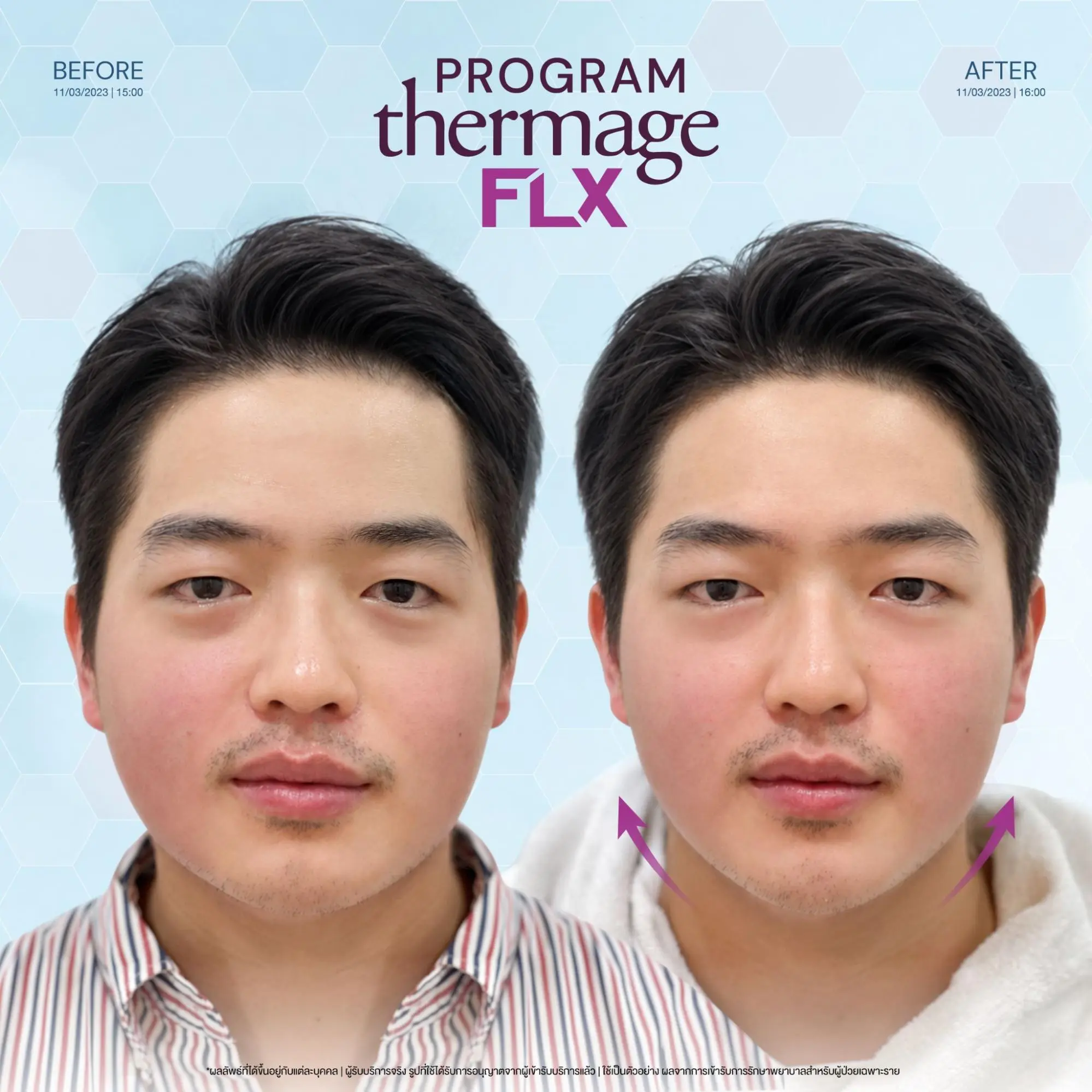 โปรแกรม Ulthera vs Thermage เครื่องยกกระชับใบหน้าแบบไหนเหมาะกับคุณ? 5 Thermage กับ Ulthera เห็นผลเมื่อไหร่