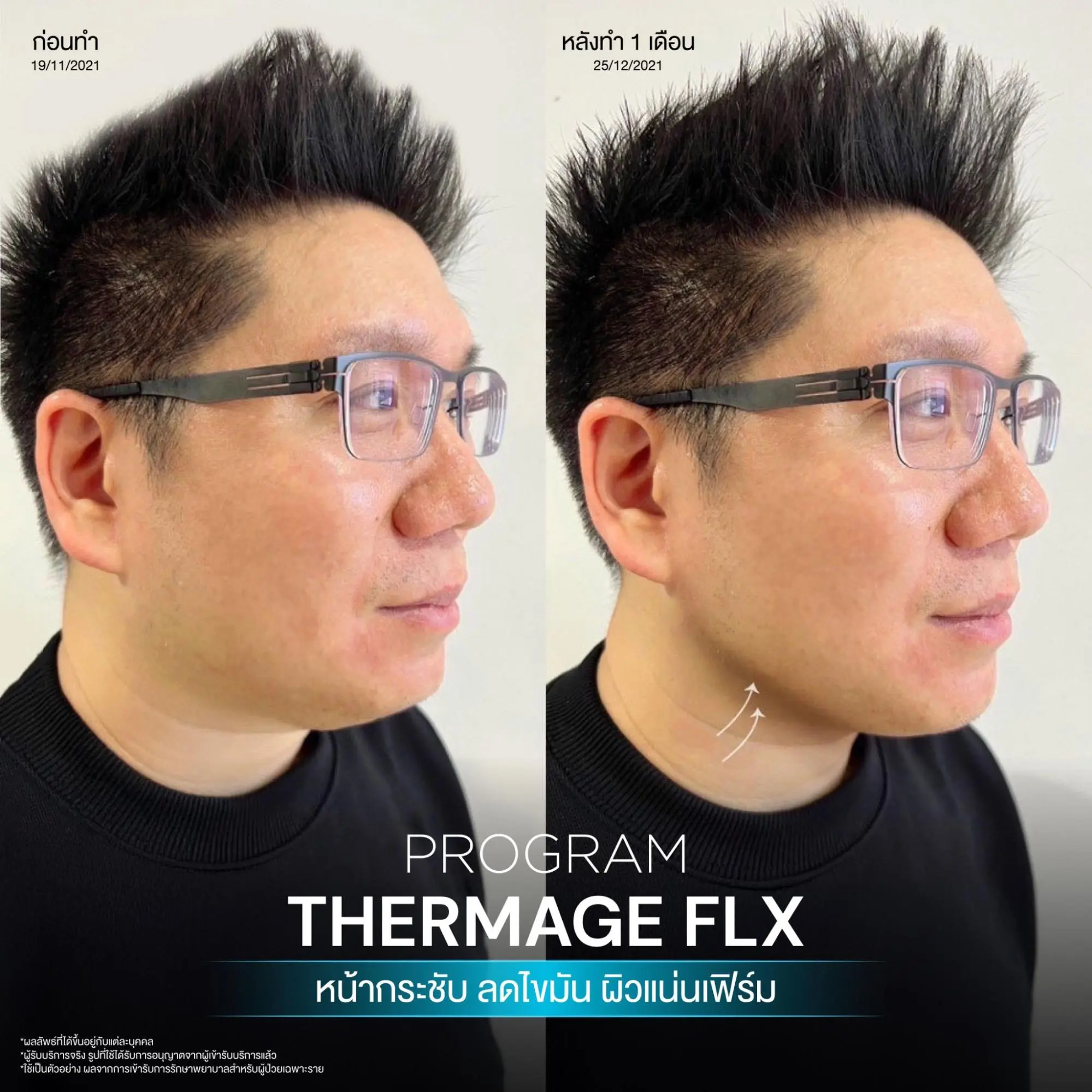 โปรแกรม Ulthera vs Thermage เครื่องยกกระชับใบหน้าแบบไหนเหมาะกับคุณ? 2 โปรแกรมเทอร์มาจคืออะไร