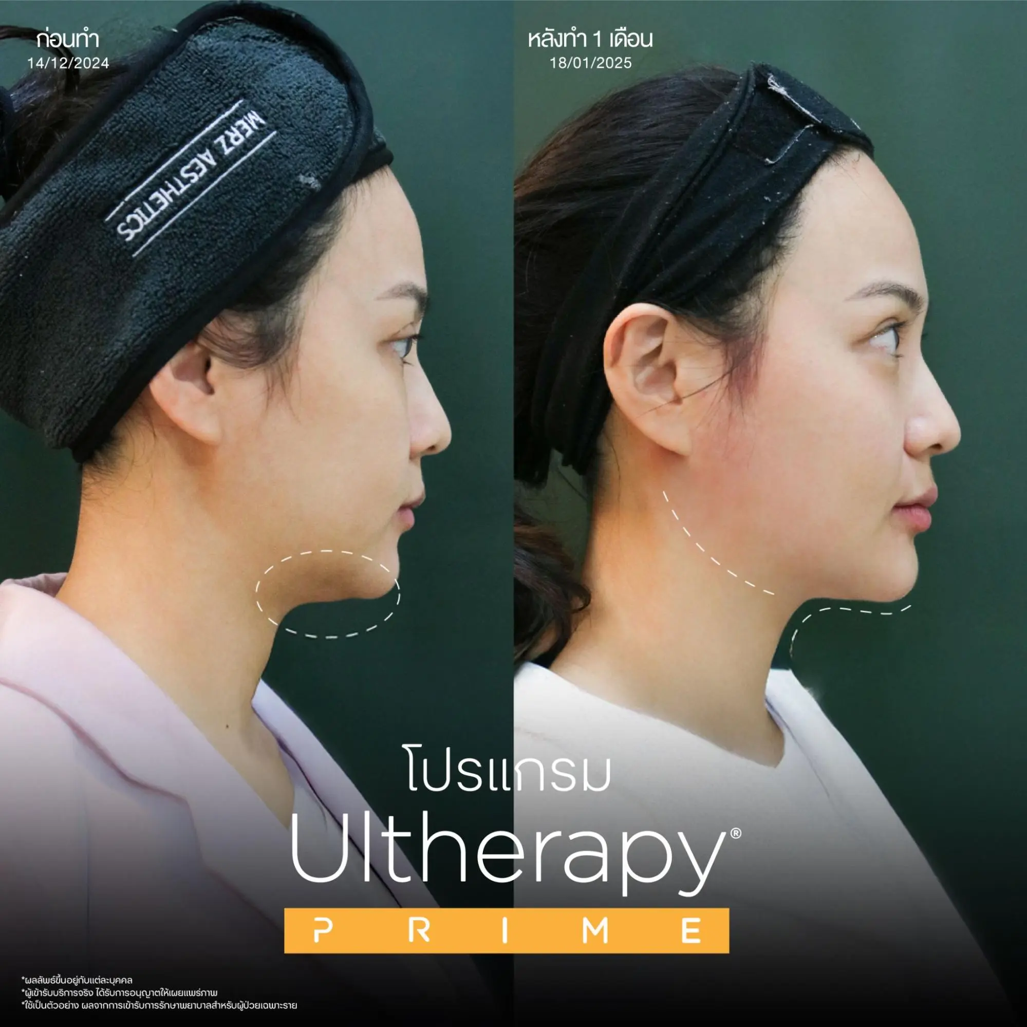 โปรแกรม Ulthera vs Thermage เครื่องยกกระชับใบหน้าแบบไหนเหมาะกับคุณ? 3 โปรแกรม Ulthera คืออะไร