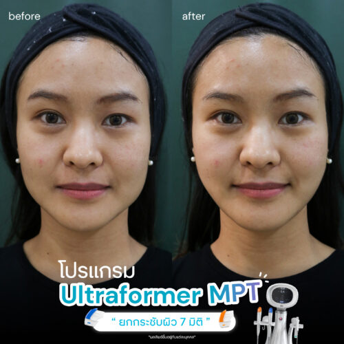 Ultraformer-MPT-review